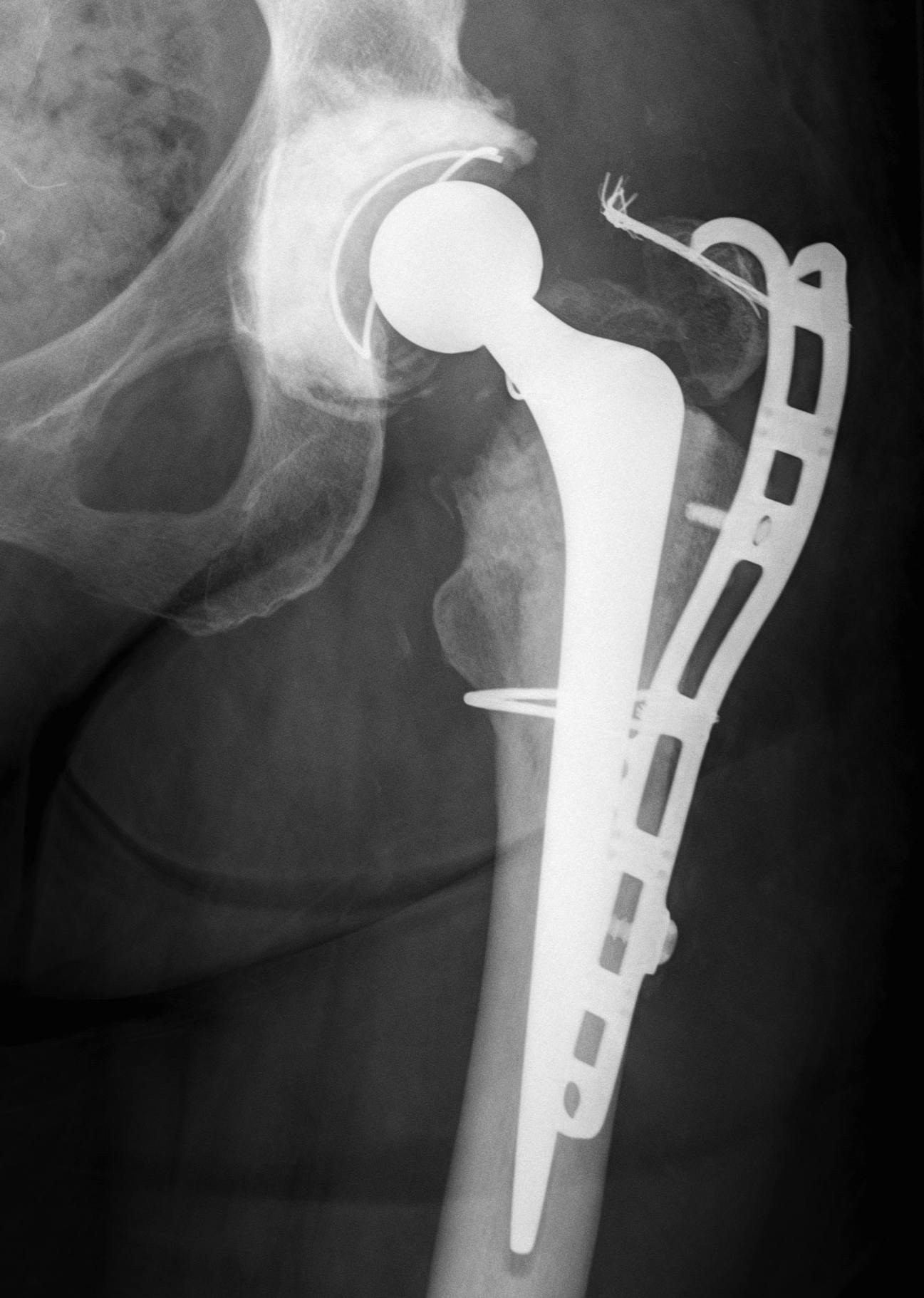 THR Periprosthetic Fracture A Plating